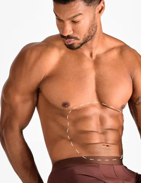 Abdomen – Epilare Definitivă cu Laser - 4 Sedinte