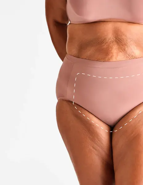 Brazilian feminin – Epilare Definitivă cu Laser - 1 Sedinte