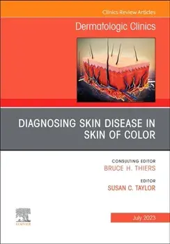 Diagnosing Skin Disease in Skin of Color, An Issue of Dermatologic Clinics, Hardback/***