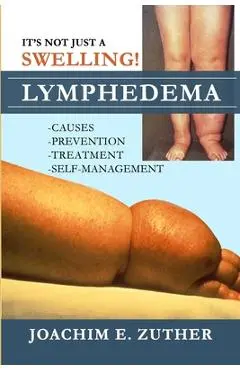 It's Not Just a Swelling! Lymphedema: Causes, Prevention, Treatment, Self-Management - Joachim Zuther