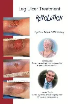 Leg Ulcer Treatment Revolution, Paperback/Mark S. Whiteley