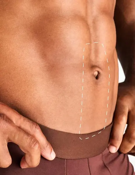 Linia mediană abdominală – Epilare Definitivă cu Laser - 4 Sedinte