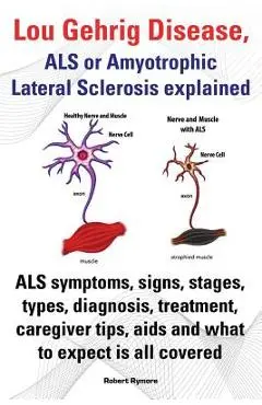 Lou Gehrig Disease, ALS or Amyotrophic Lateral Sclerosis Explained. ALS Symptoms, Signs, Stages, Types, Diagnosis, Treatment, Caregiver Tips, AIDS and - Robert Rymore