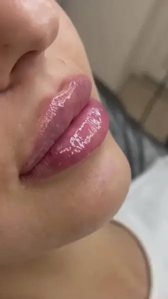 Mărire Buze - Juvederm 1ml