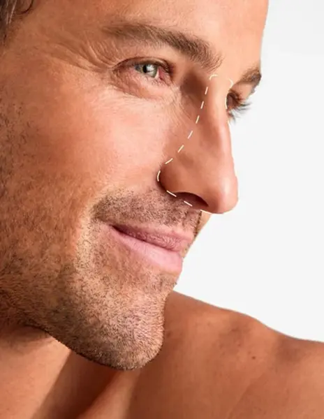 Nas - Laser Hair Removal - 1 Sedinte