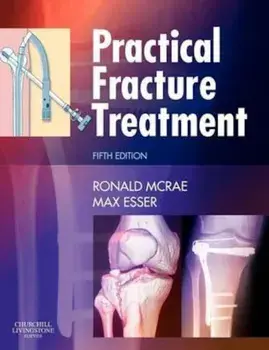 Practical Fracture Treatment, Paperback/Ronald McRae