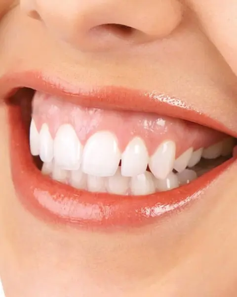 Tratamentul Zâmbetului Gingival - Default Title