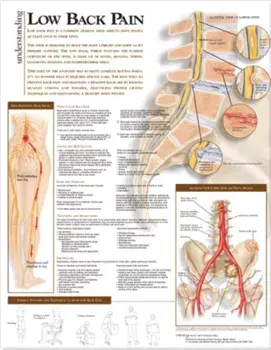 Understanding Low Back Pain Anatomical Chart/***